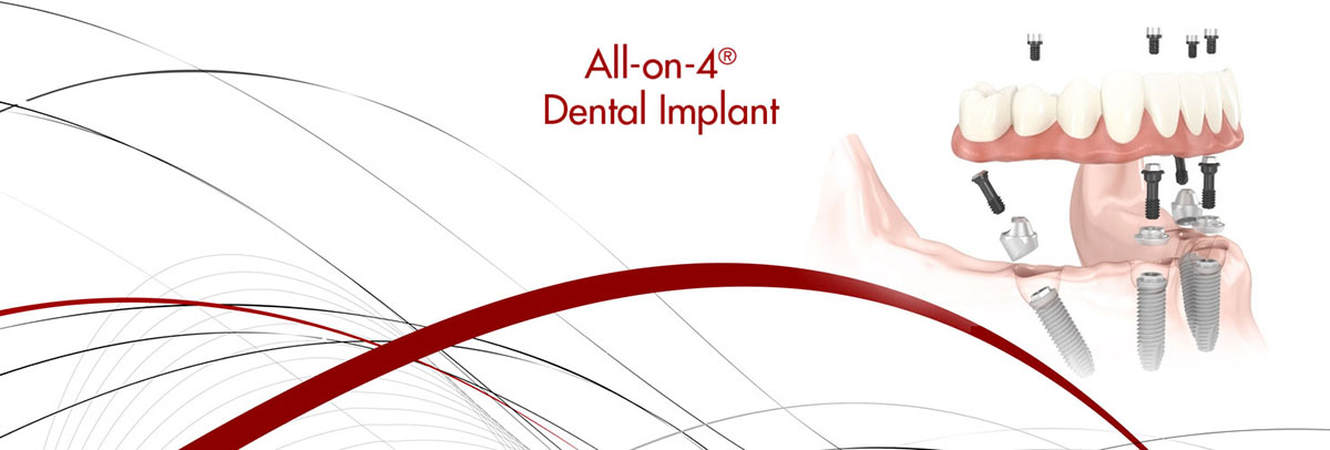 Dunwoody All-on-4 Dental Implants