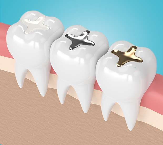 Dunwoody Tooth Colored Fillings