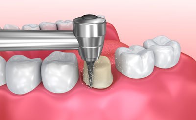 Dental Crowns