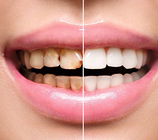 Dunwoody Dental Implant Restoration