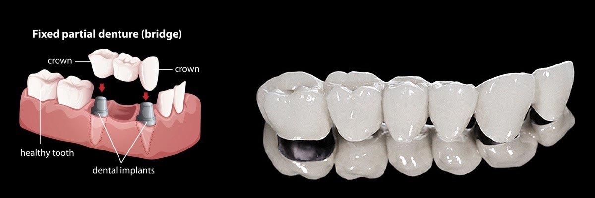 Dunwoody Dentures