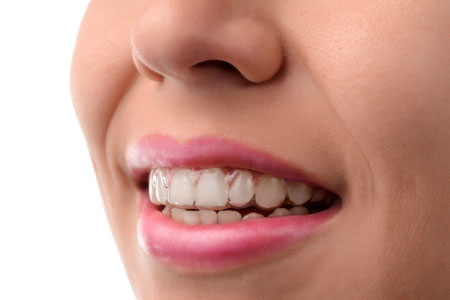 Invisalign