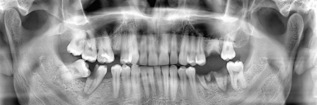 Dunwoody Wisdom Teeth Extraction